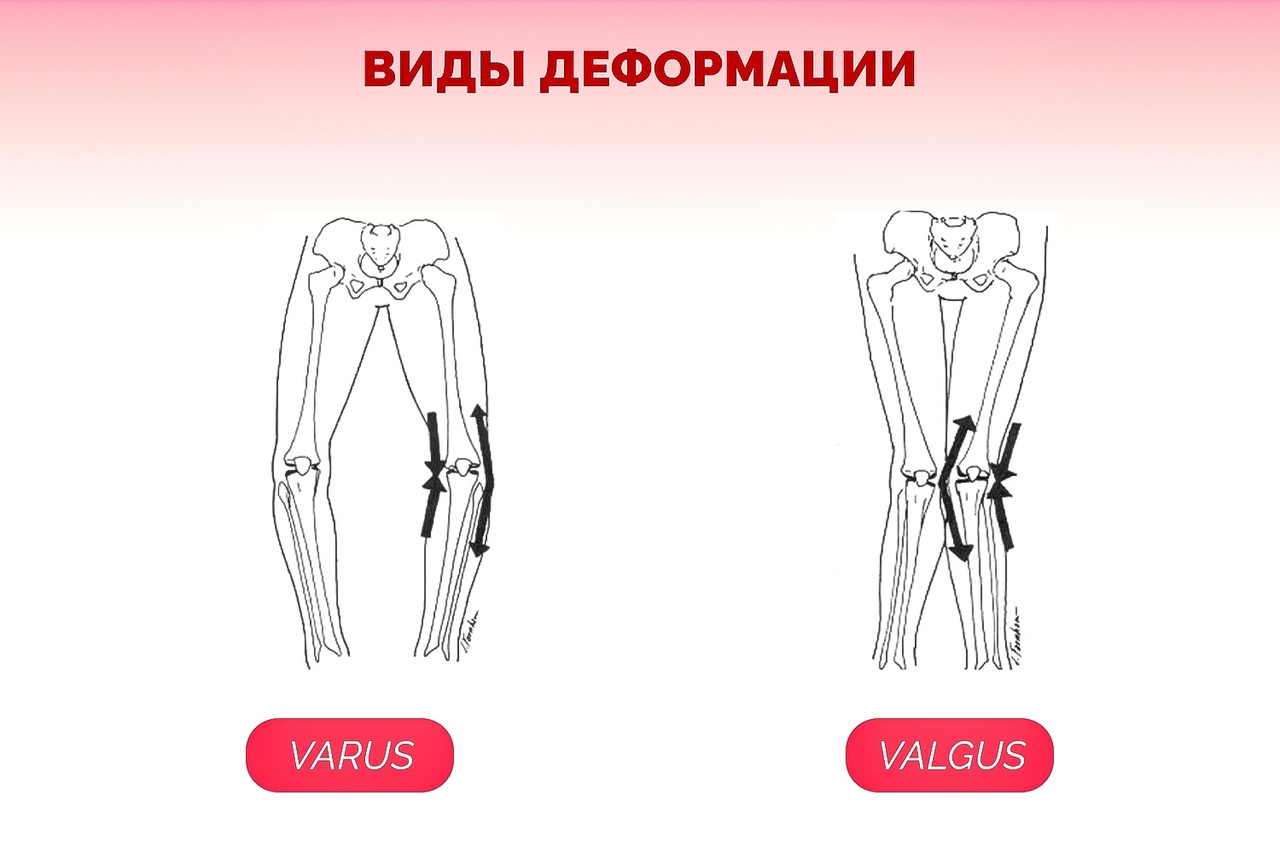 Варусная деформация коленных суставов. Варусная деформация коленных суставов рентген. Варусной деформации коленных суставов. Варусная деформация коленных суставов у детей.